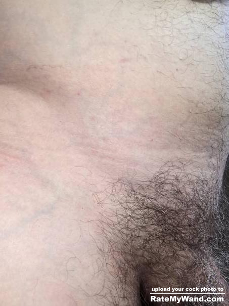 Two ilioinguinal nerve Injections yesterday... - Rate My Wand